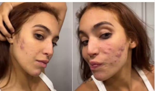 Farmacêutica explica: influenciadora disse que teve reação na pele após o uso de medicamentos