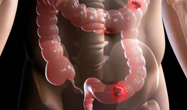 Brasileiros desenvolvem tratamento contra o câncer de intestino que será testado na Europa