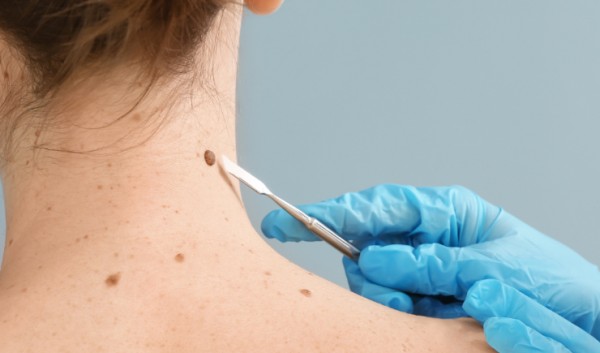 Instituto Nacional de Câncer (Inca) projeta mais de 704 mil casos novos da doença entre 2023 e 2025