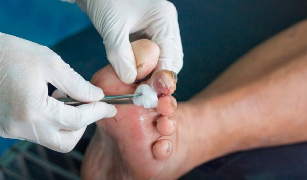 Pesquisadores desenvolvem hidrogel anti-inflamatório de baixo custo capaz de tratar feridas crônicas