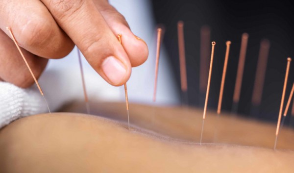 Projeto que inclui farmacêuticos no exercício da acupuntura segue para votação em Plenário do Sena